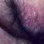 15. Genital Herpes Infection Pictures