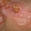 17. Genital Herpes Infection Pictures