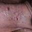 18. Genital Herpes Infection Pictures