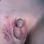 19. Genital Herpes Infection Pictures