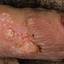 20. Genital Herpes Infection Pictures