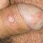 21. Genital Herpes Infection Pictures