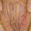 23. Genital Herpes Infection Pictures