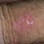 27. Genital Herpes Infection Pictures