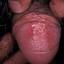 32. Genital Herpes Infection Pictures
