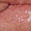 36. Genital Herpes Infection Pictures
