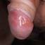 41. Genital Herpes Infection Pictures