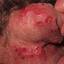 43. Genital Herpes Infection Pictures