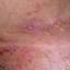 8. Genital Herpes Infection Pictures