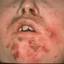 3. Sycosis Barbae Nose Pictures