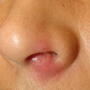 Furuncle in Nose
