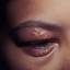1. Herpes Simplex on Eyelid Pictures