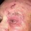 11. Herpes Simplex on Eyelid Pictures