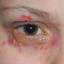 12. Herpes Simplex on Eyelid Pictures
