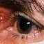 13. Herpes Simplex on Eyelid Pictures