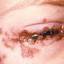 14. Herpes Simplex on Eyelid Pictures
