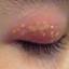 2. Herpes Simplex on Eyelid Pictures