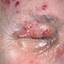 3. Herpes Simplex on Eyelid Pictures