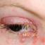 4. Herpes Simplex on Eyelid Pictures