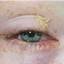 5. Herpes Simplex on Eyelid Pictures