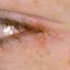 6. Herpes Simplex on Eyelid Pictures