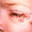 7. Herpes Simplex on Eyelid Pictures
