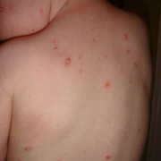 Chicken Pox Symptoms in Kids