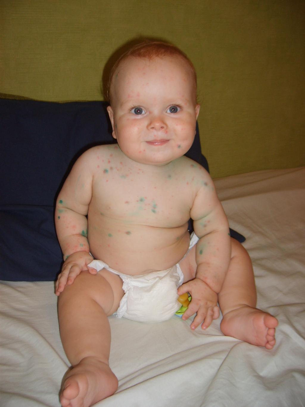 Chicken Pox Symptoms in Kids Pictures – 27 Photos & Images 