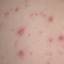 1. Symptoms of Chicken Pox Pictures