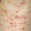 12. Symptoms of Chicken Pox Pictures