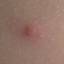 2. Symptoms of Chicken Pox Pictures