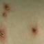 20. Symptoms of Chicken Pox Pictures