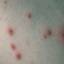 21. Symptoms of Chicken Pox Pictures