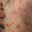 22. Symptoms of Chicken Pox Pictures