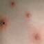 25. Symptoms of Chicken Pox Pictures