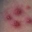 34. Symptoms of Chicken Pox Pictures