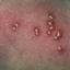 35. Symptoms of Chicken Pox Pictures