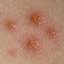 36. Symptoms of Chicken Pox Pictures