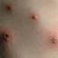 37. Symptoms of Chicken Pox Pictures