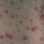 38. Symptoms of Chicken Pox Pictures