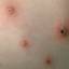 39. Symptoms of Chicken Pox Pictures