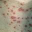 30. Signs of Chickenpox Pictures