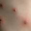 32. Signs of Chickenpox Pictures