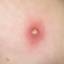 9. Signs of Chickenpox Pictures