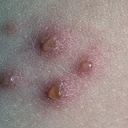 Early signs of chickenpox