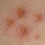 8. Early signs of chickenpox Pictures