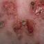 41. Pemphigus Disease Pictures
