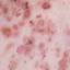 48. Pemphigus Disease Pictures