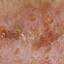 8. Pemphigus Disease Pictures