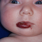 Hemangioma of Lips